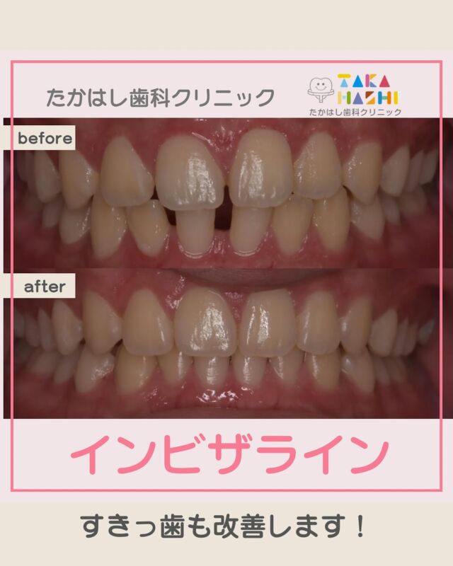 こんにちは！たかはし歯科クリニックです🏥

マウスピース矯正のインビザラインを使用したすきっ歯（空隙歯列）が改善した症例をご紹介します🦷✨

〔主訴〕
歯の隙間が空いていている。

〔治療内容〕
インビザラインによるマウスピース矯正
歯と歯の間をほんの少しだけ削るIPRと、
顎間ゴムを併用し、隙間を閉じて噛み合わせを整えました。

〔治療期間〕
アライナー39枚使用（1週間で一枚）
→約9ヶ月の治療予定

〔治療費〕
880,000円+診断料33,000
（検査・診断・治療費すべて込み）

〔矯正治療のリスク・副作用について）
・治療中の痛み
・歯根吸収の可能性
・後戻りのリスク

無料カウンセリング受付中です！
ご相談だけでも大歓迎です！
何か気になることがあれば、お気軽にお問い合わせください🧡

#インビザライン#たかはし歯科クリニック